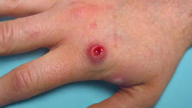 Comprendere il vaiolo delle scimmie e come prevenirlo？