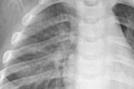 Rilevazione rapida di Chlamydia pneumoniae: affidabile ed efficiente