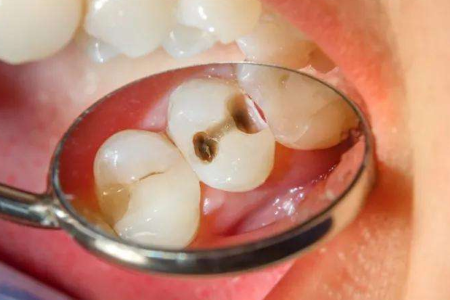 Nadio lancia un mezzo di arricchimento della carie avanzato per il rilevamento del decadimento dei denti precoci